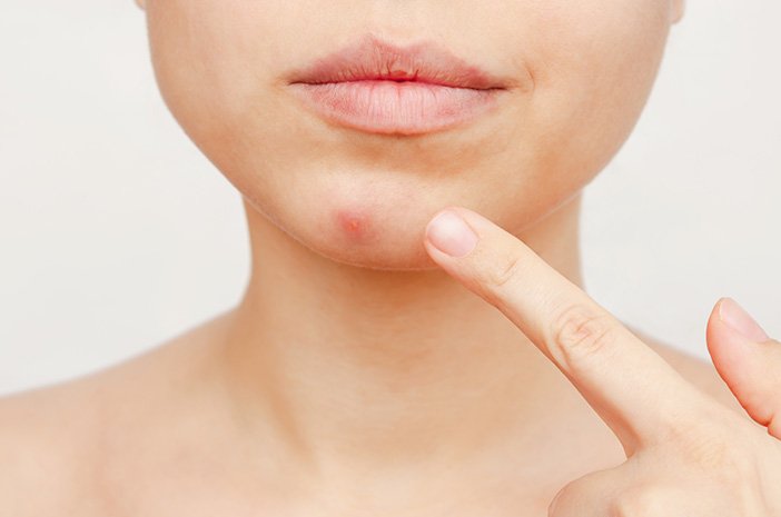 Jerawat di Dagu: Penyebab dan Cara Mengatasinya