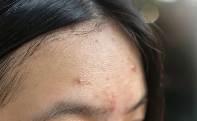 Penyebab Jerawat di Dahi dan Cara Mengatasinya