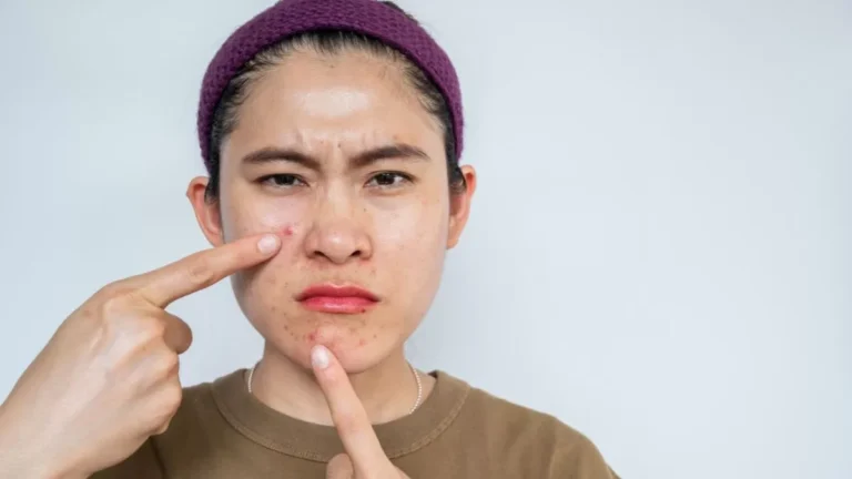 Penyebab Jerawat di Pipi dan Cara Mengatasinya