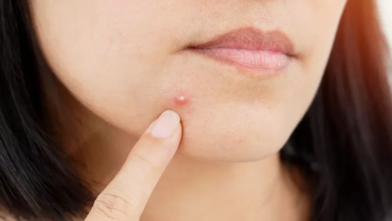 Kenapa Jerawat Sering Muncul di Wajah? Ini Penjelasannya