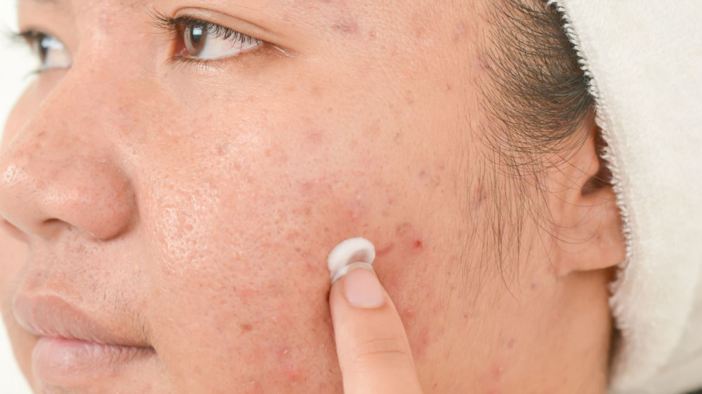 Apa Itu Salicylic Acid dan Cara Kerjanya pada Kulit