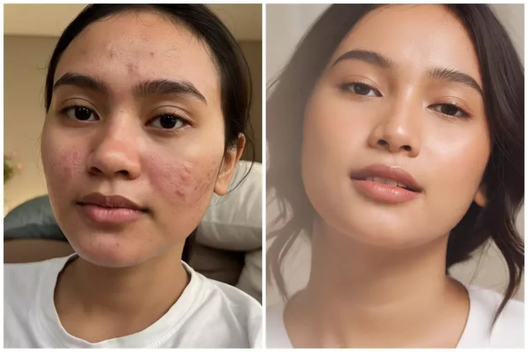 Tips Skincare agar Kulit Tidak Mudah Berjerawat